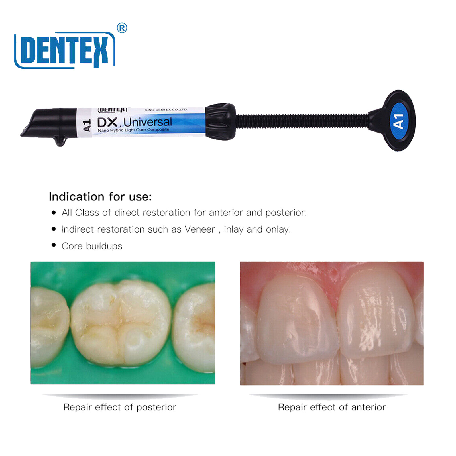 DENTEX Universal Dental Light Cure Nano Hybrid Fluoride Release Composite Resin