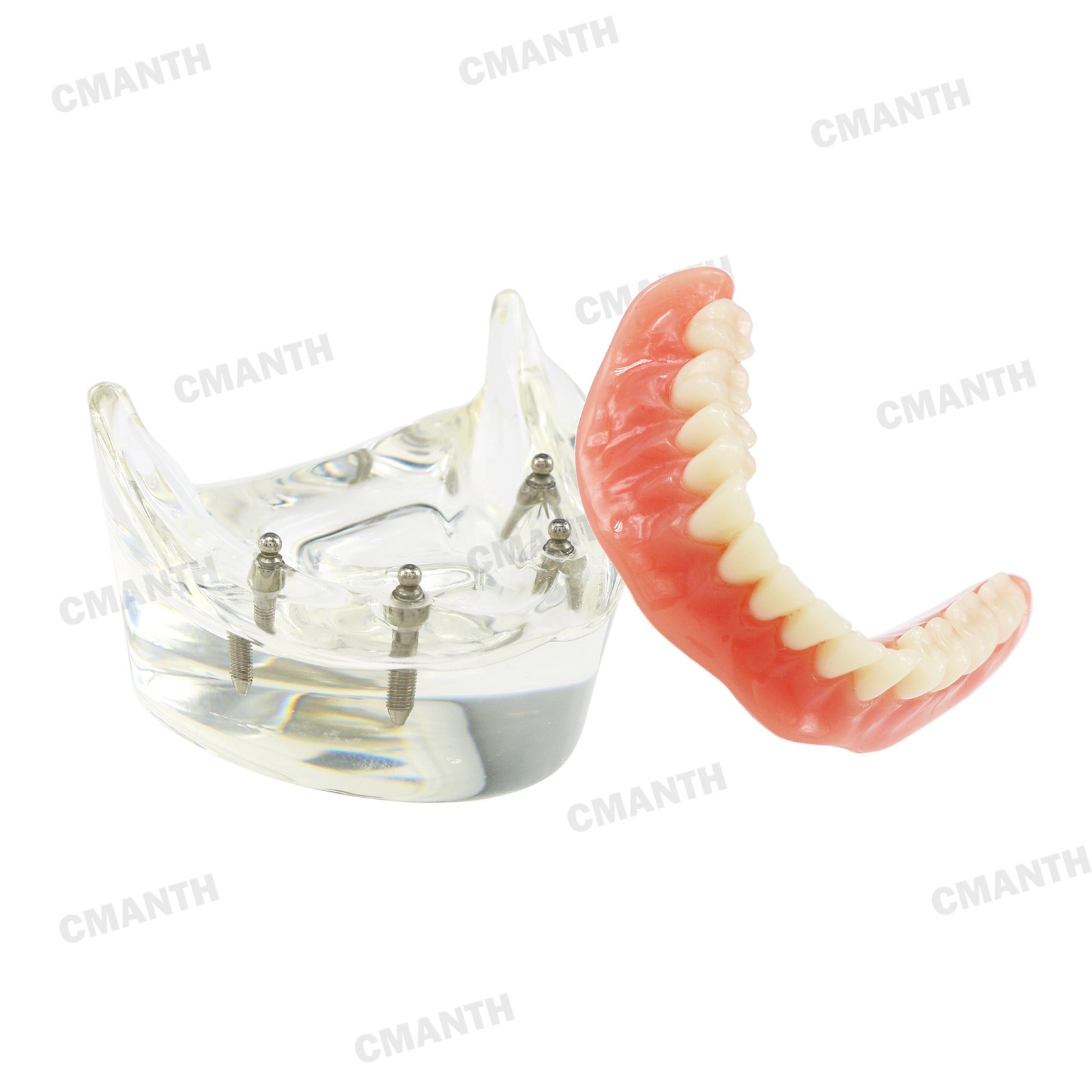 US Dental Model Removable Overdenture Teeth Upper/Lower Jaw 4 Implants Model