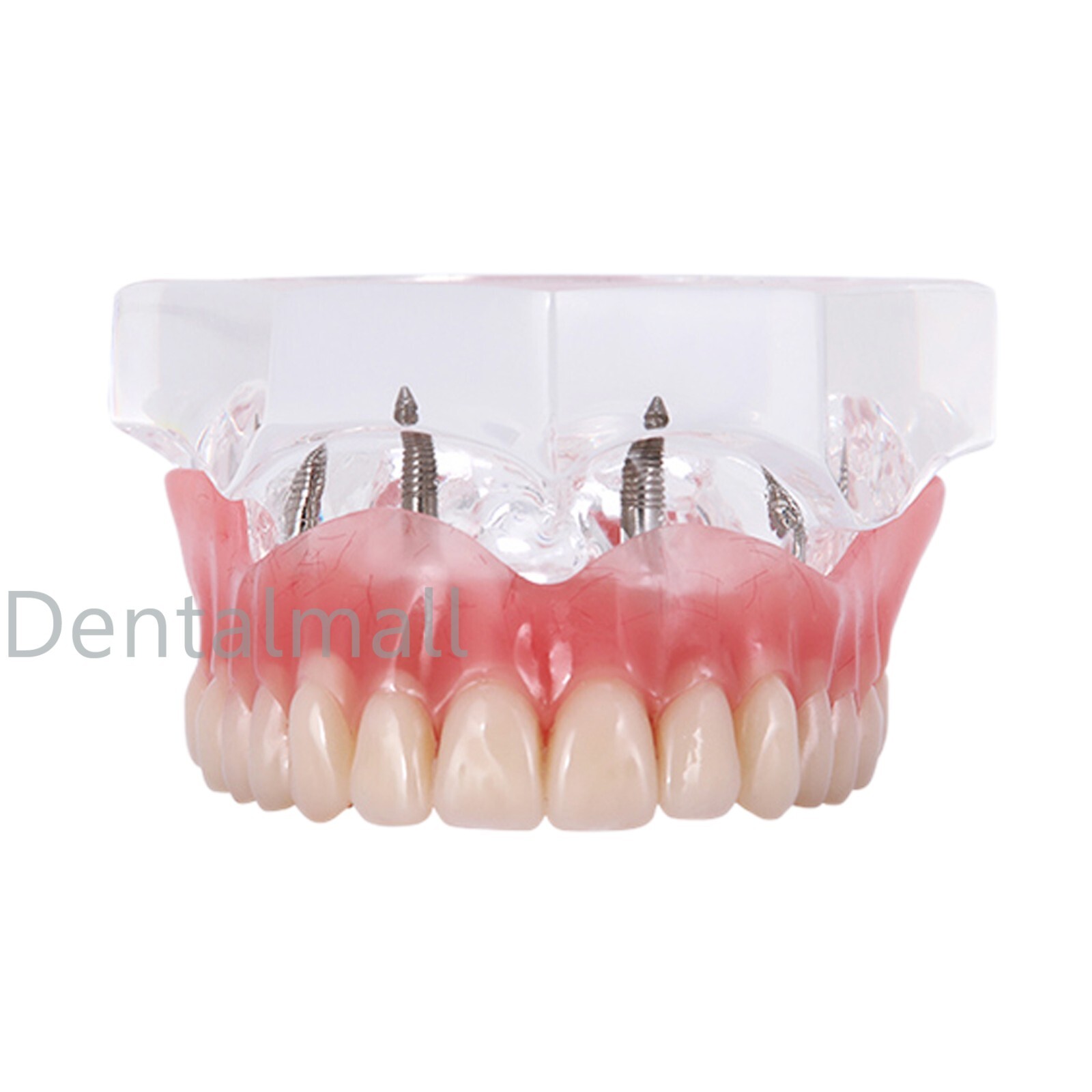 Dental Typodont Teeth Model Overdenture Implant Practice Endo Ortho Teachi Study