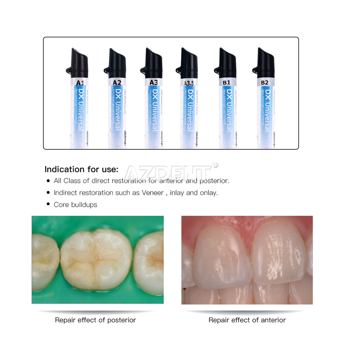 USA Dental Universal Light Cure Composite Resin A1,A2,A3,A3.5,B1,B2 4g/Syringe