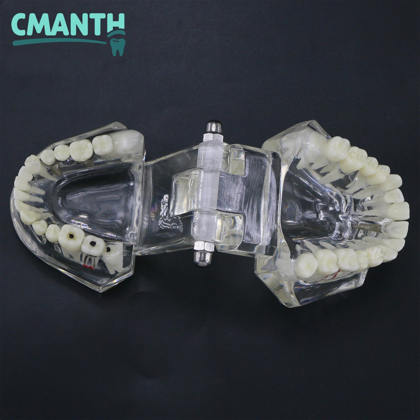 Dental Model Bridge Restoration Pathology Study Demo Teaching Model M2001