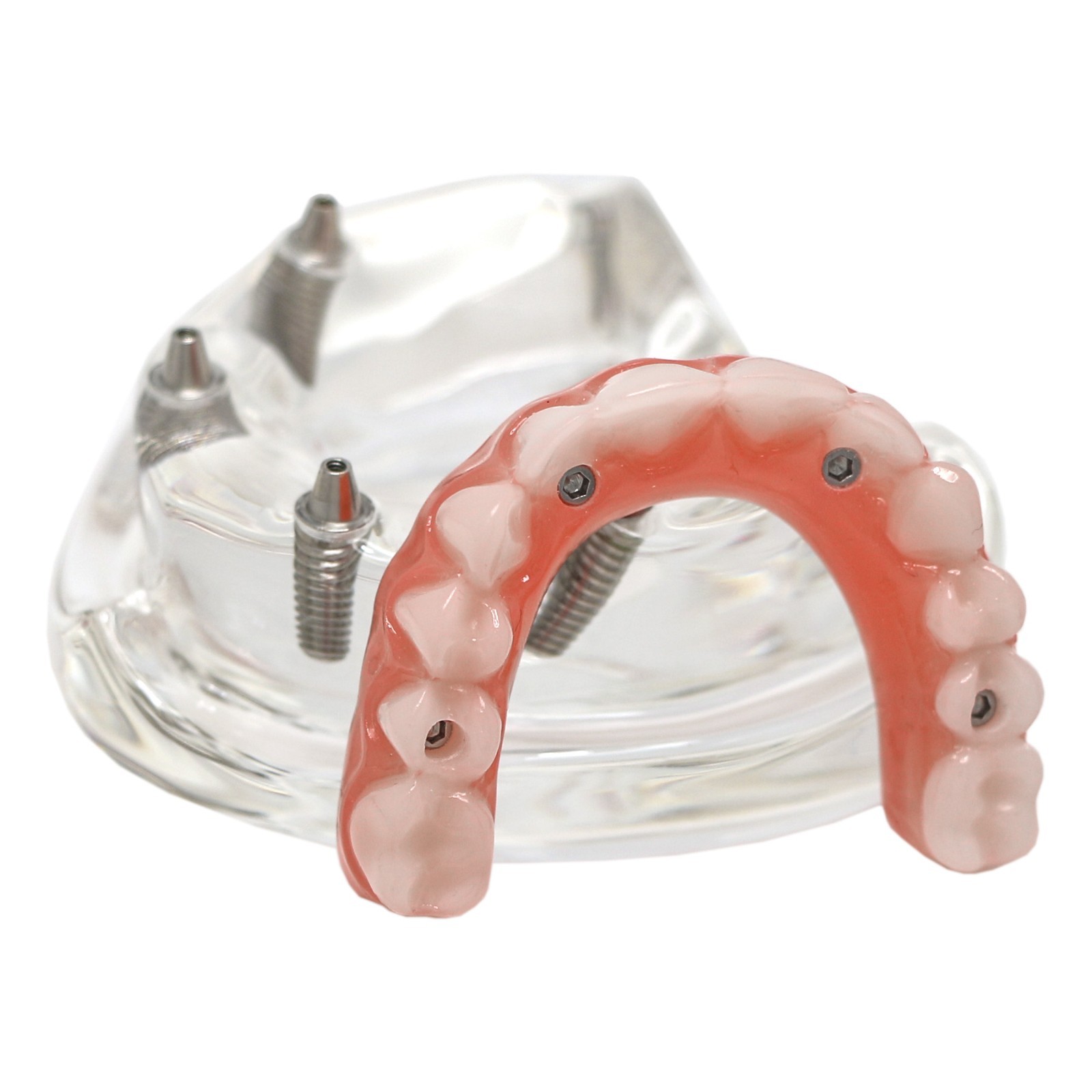 US Dental Implant Teeth Model Overdenture All on 4/All on 6 treatment Demo Model