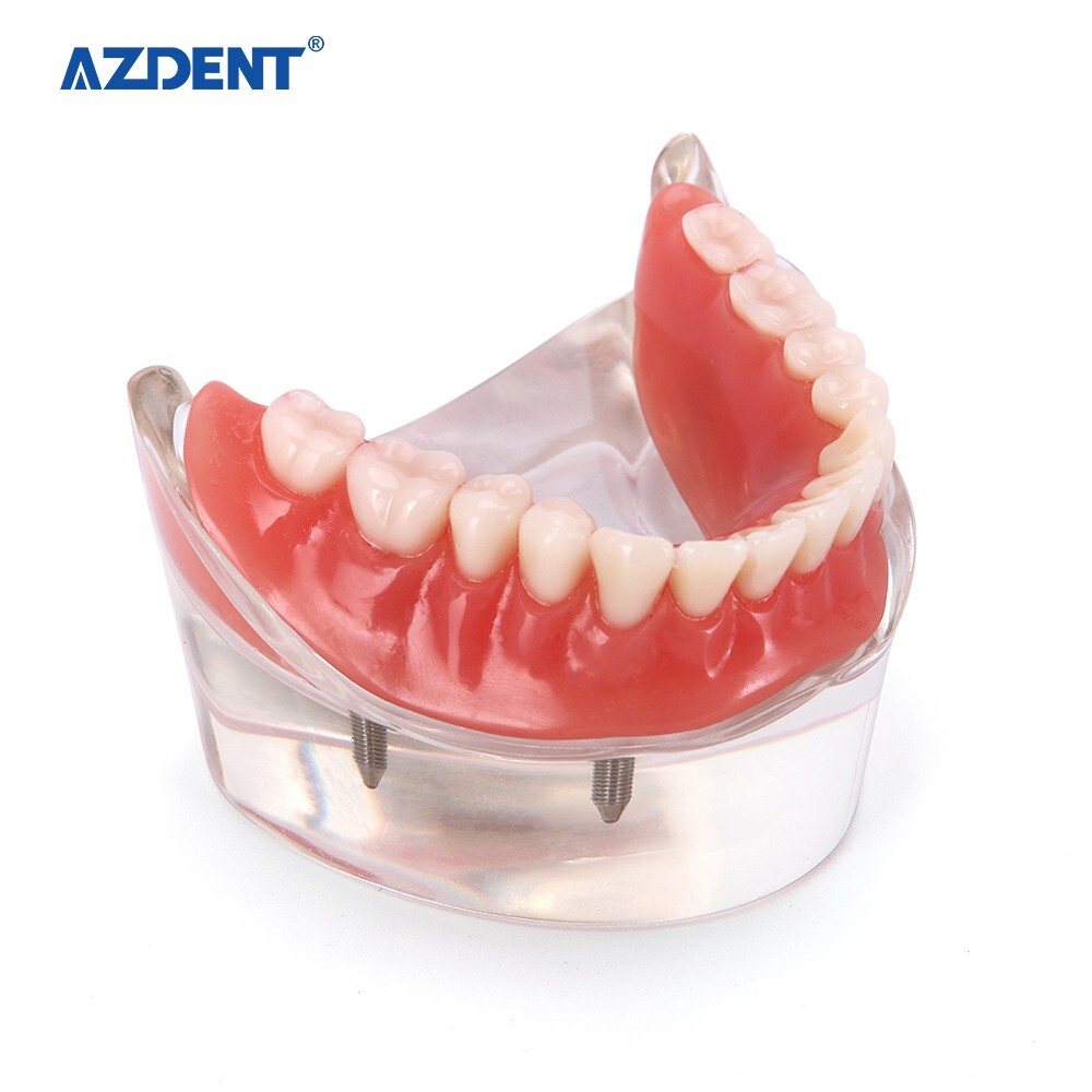 Dental Demonstration 4 Implants Teeth Model Typodont Inferior Overdenture Lower