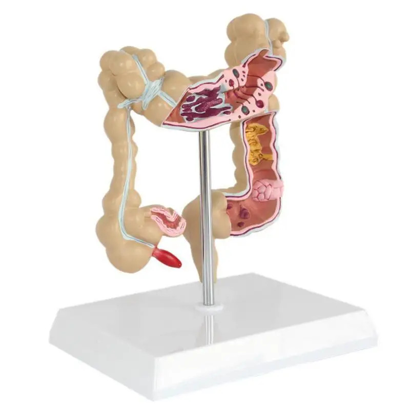 Colorectal Lesion Model Human Colon Large Intestine Pathological Diseases Model