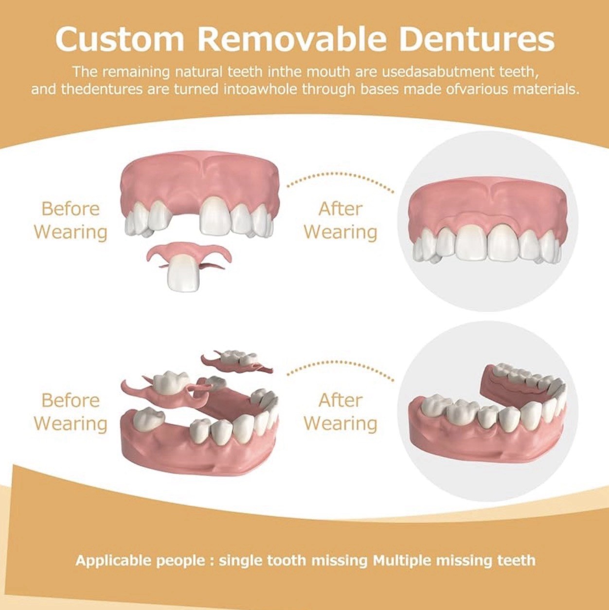 Initsmil Impression Kit 10 Pcs. Start Your Journey To A Perfect Smile