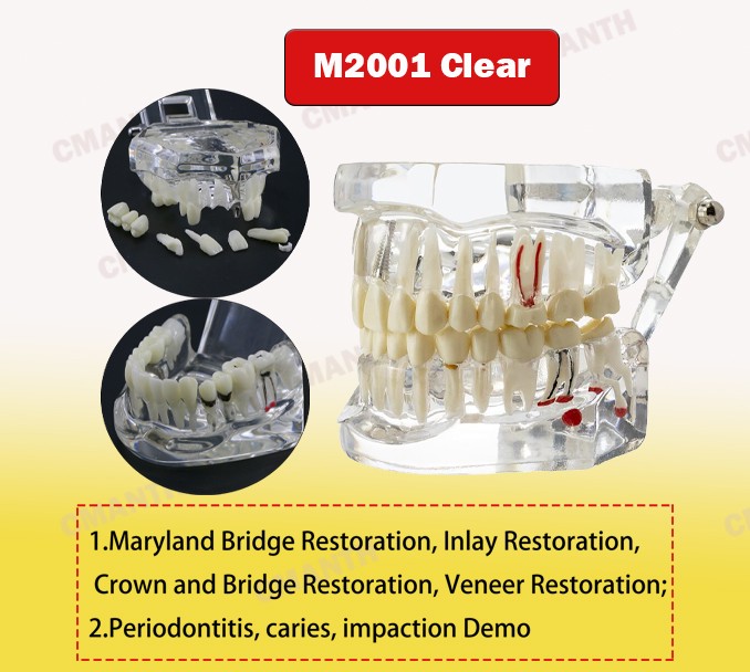 Dental Teeth Model Ortho Implant Practice Teaching of Implants Demo Model