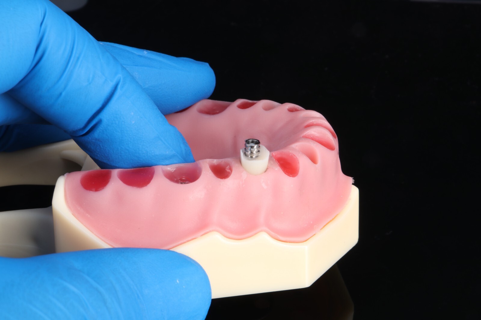 Natural Emergence Profiler, Dental Implant,Dental Laboratory,Dentistry