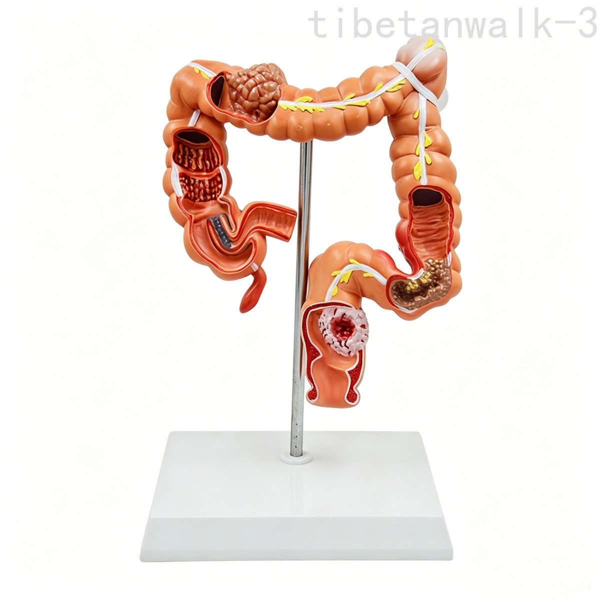 Colon Disease Model Large Intestine Appendix Pathology Model
