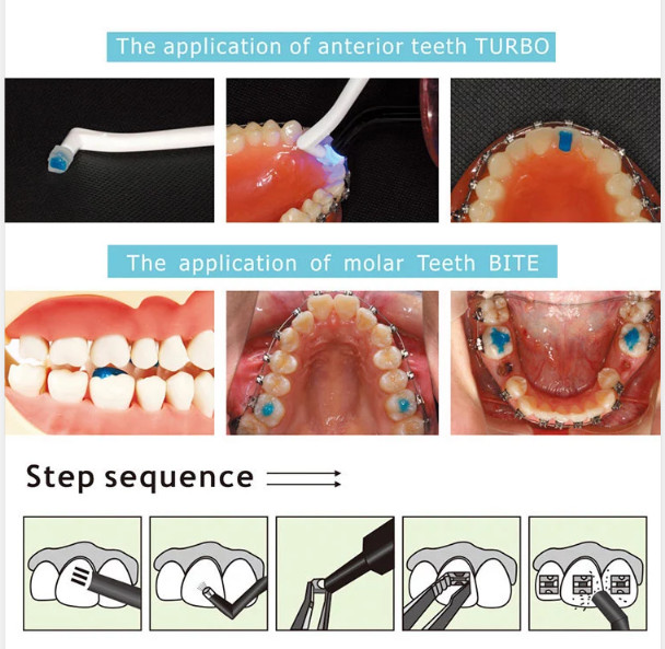 Dental TURBO Blue Glue Composite Resin 5ml Orthodontic Adhesive Light Cure Band