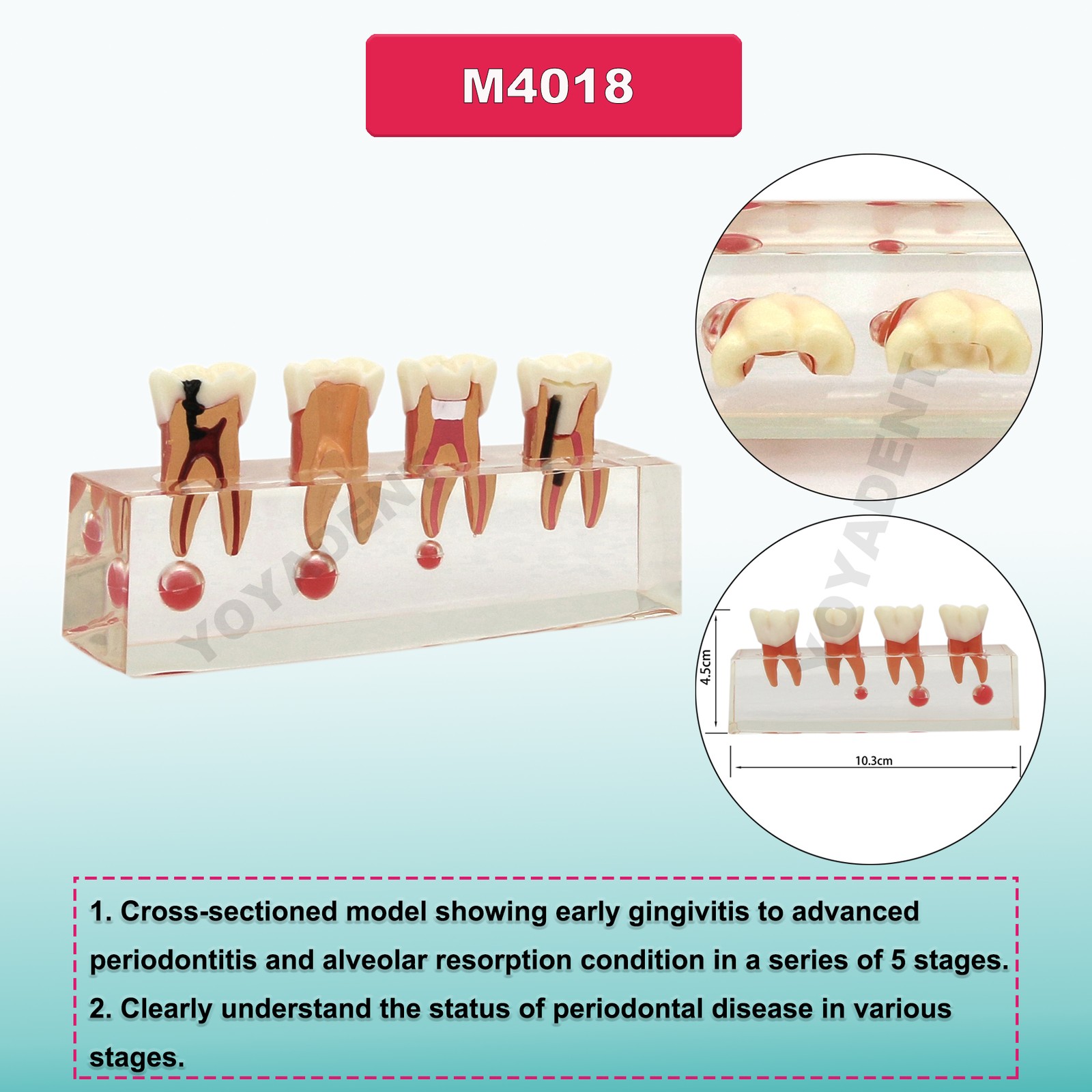 Dental Teeth Model Upper Lower Jaw 4 Overdenture Practice Implant Typodont Demo