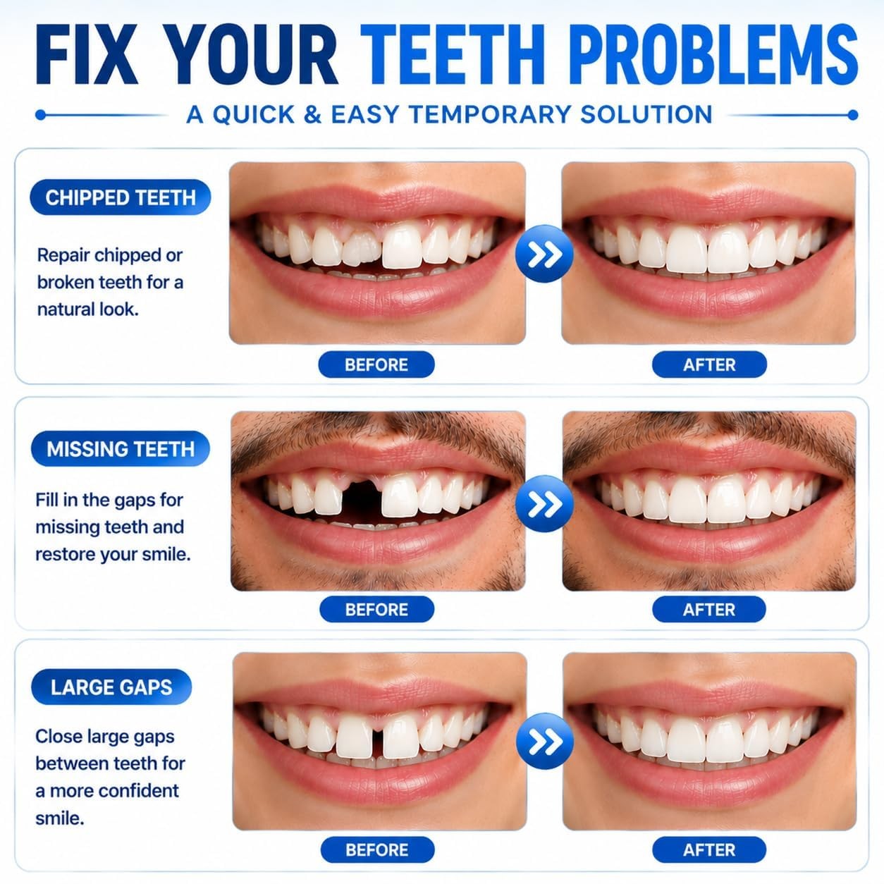 Sukh 10.9oz Moldable False Teeth Beads – Tooth Repair Kit,Repair Small, White