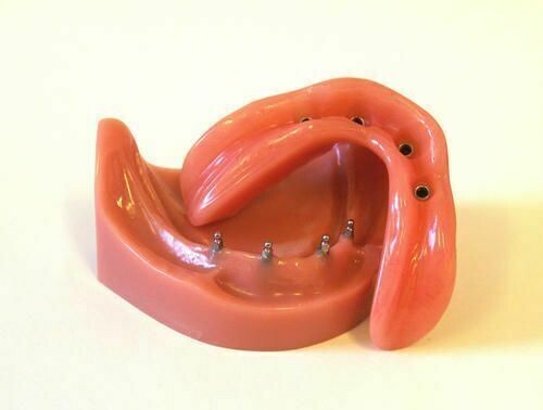 DENTAL IMPLANT 0-RINGS