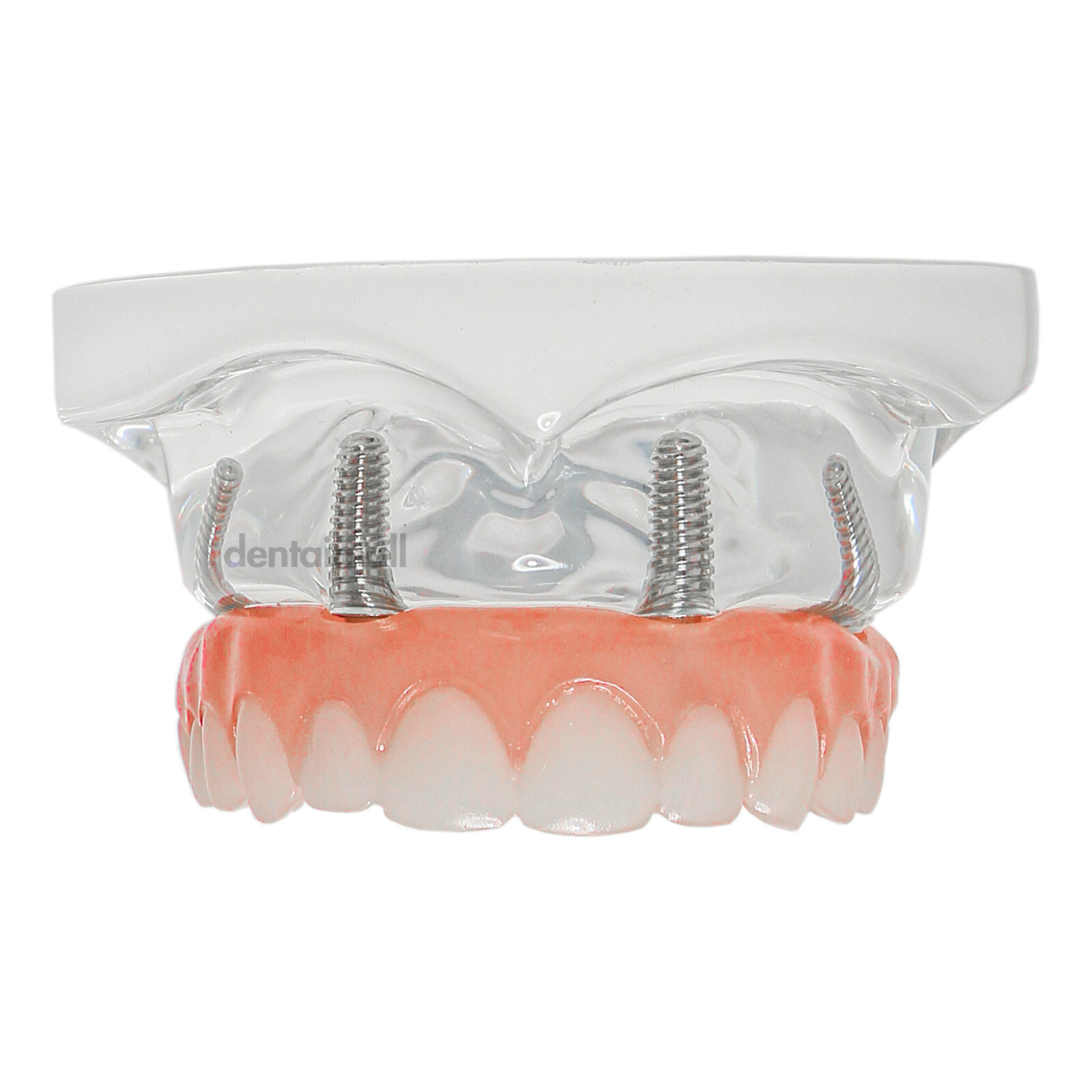 US Dental 4 Screws Overdenture Model All on 4 Restoration Upper/Lower Jaw Type