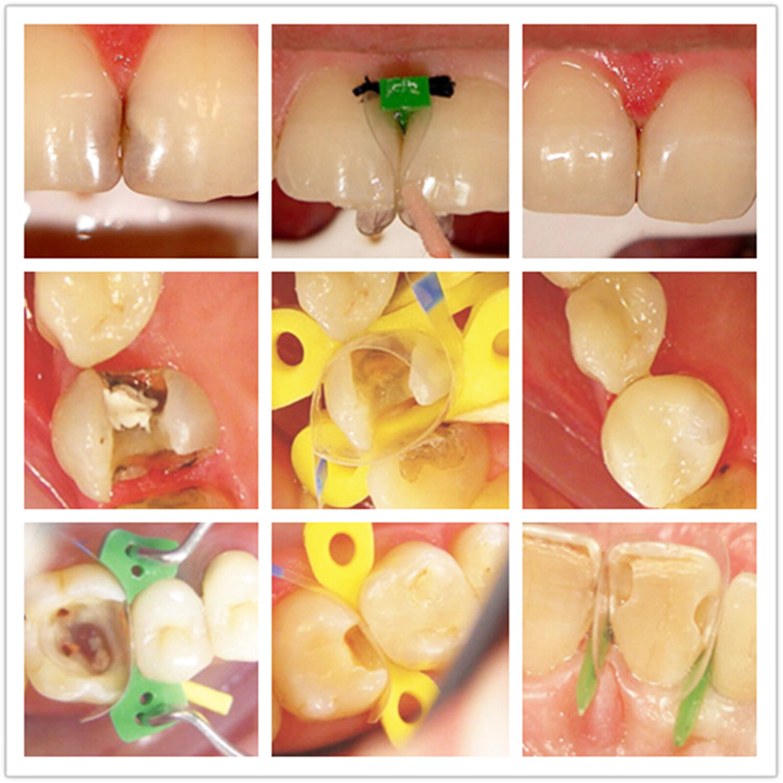 Dental Transparent Matrix Transparent Sectional Matrices Polyester Matrice Bands