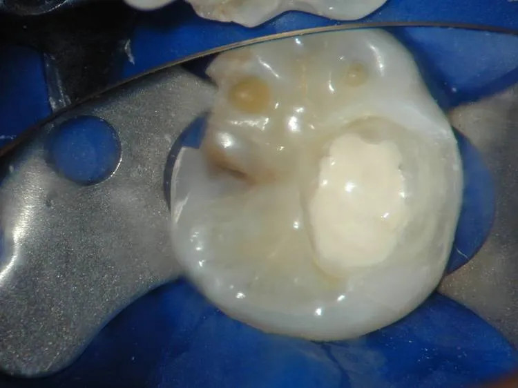 Medicept is a versatill material designed to serve as a liner and base PACK OF 1