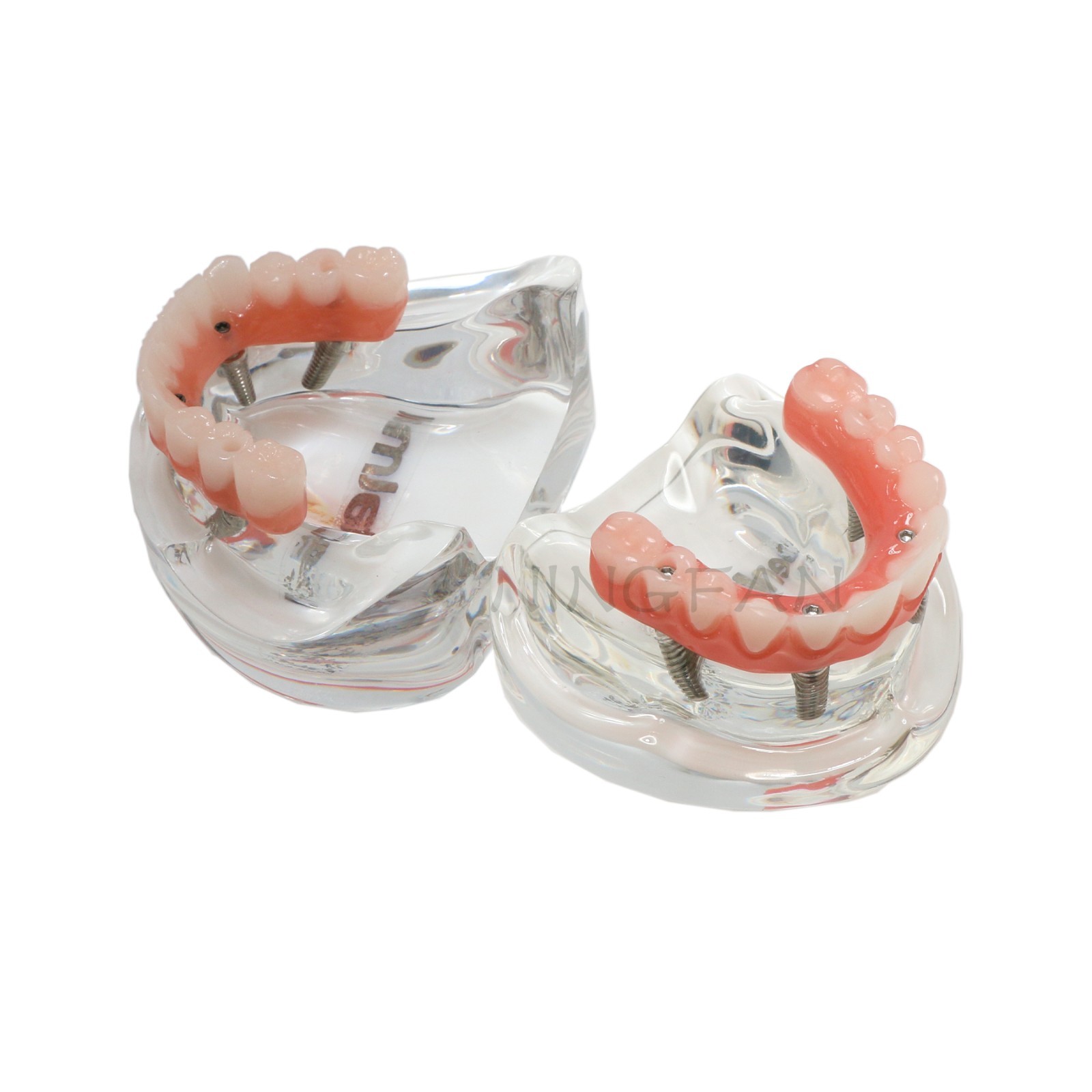 US Dental Implant Teeth Model Overdenture All on 4/All on 6 treatment Demo Model