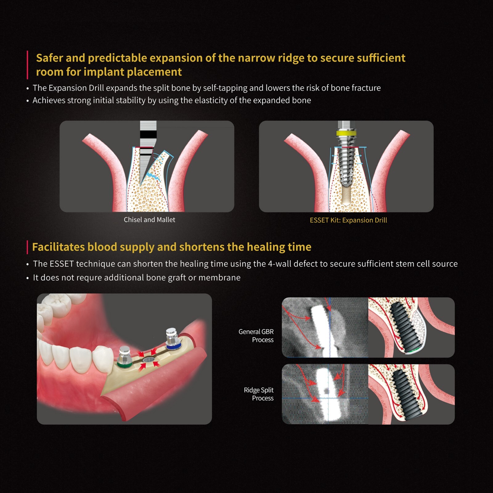 Implant ESSET Kit Easy Split Expansion of the Narrow Ridge HIOSSEN OSSTEM Style