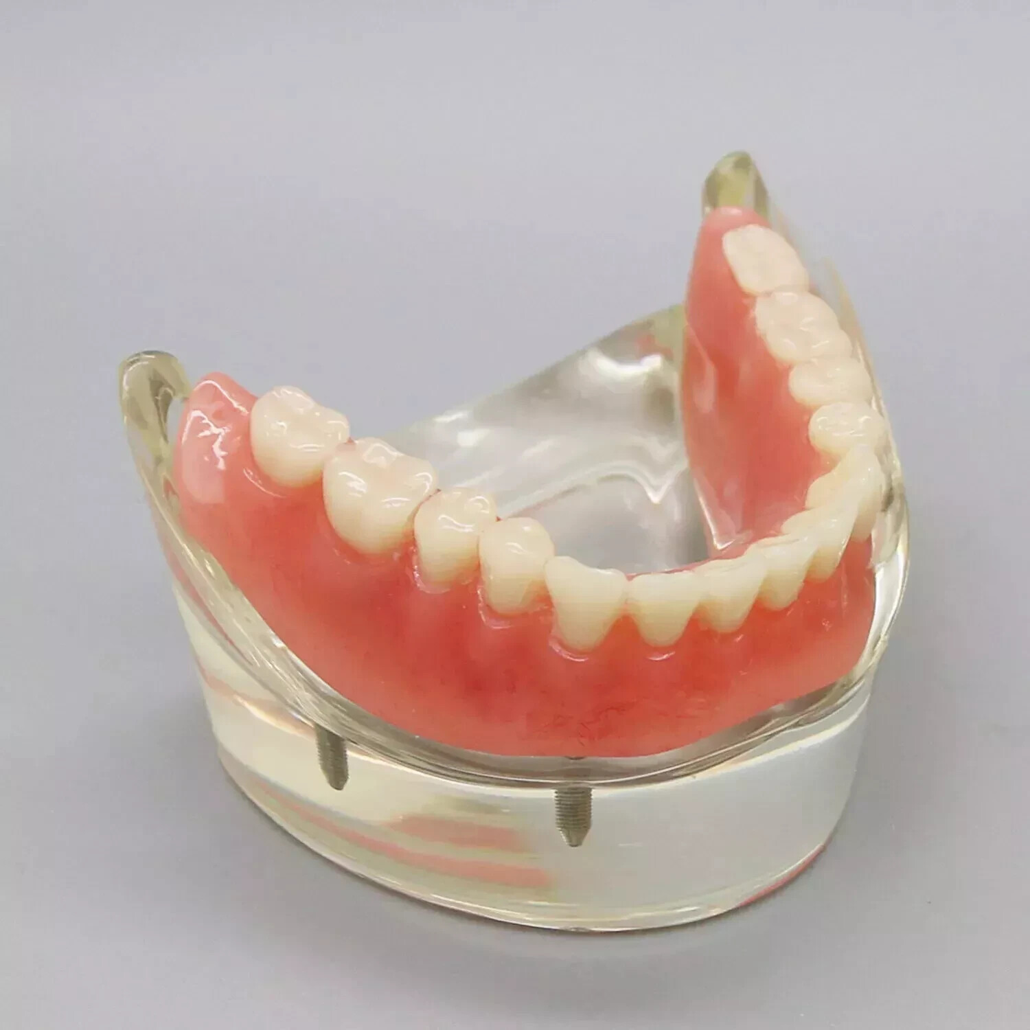 1Pc Dental 4 Implants Lower Overdenture Restoration Implant Typodont Model #6003