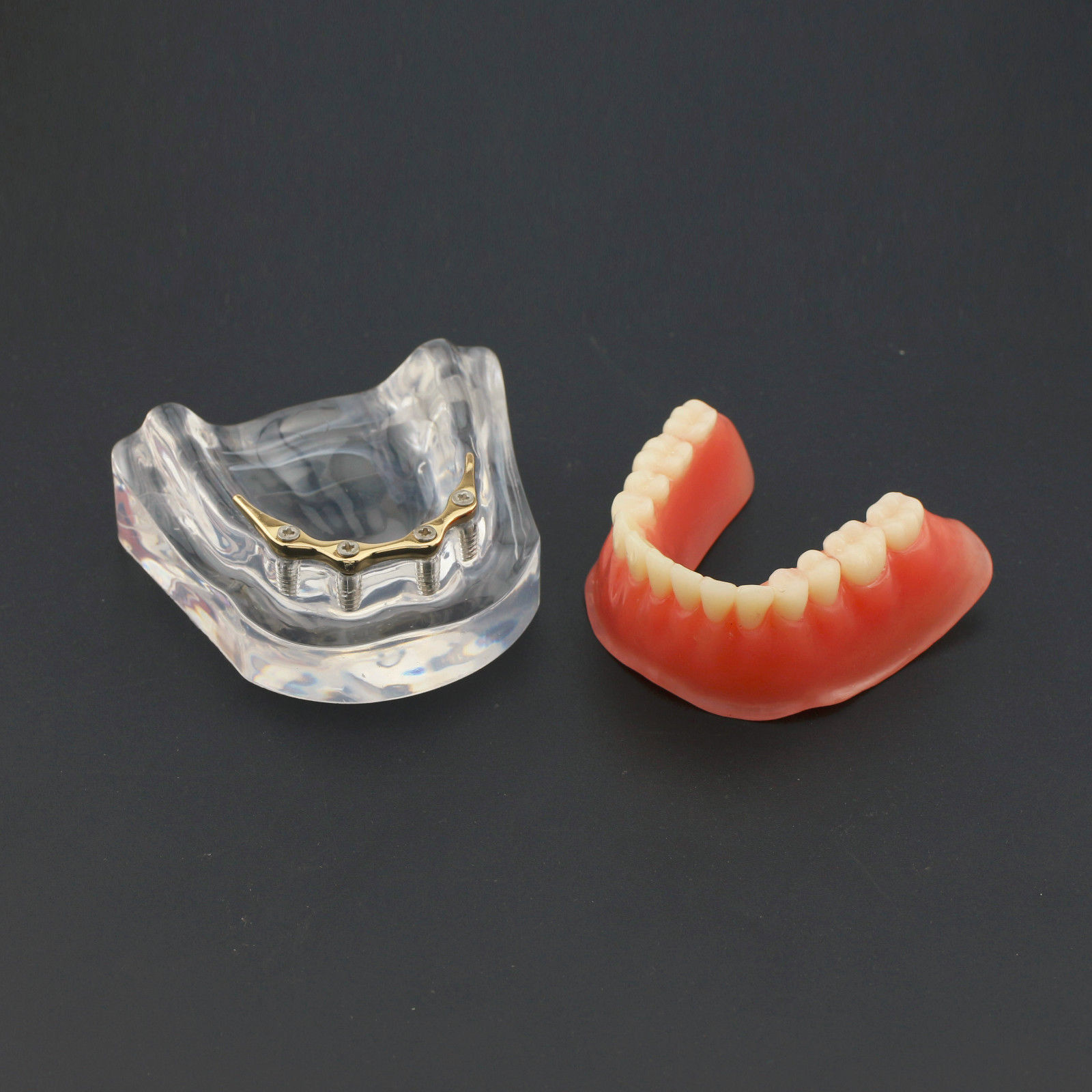 Dental Implants Restoration Model Overdenture Inferior With Demo Teaching Study