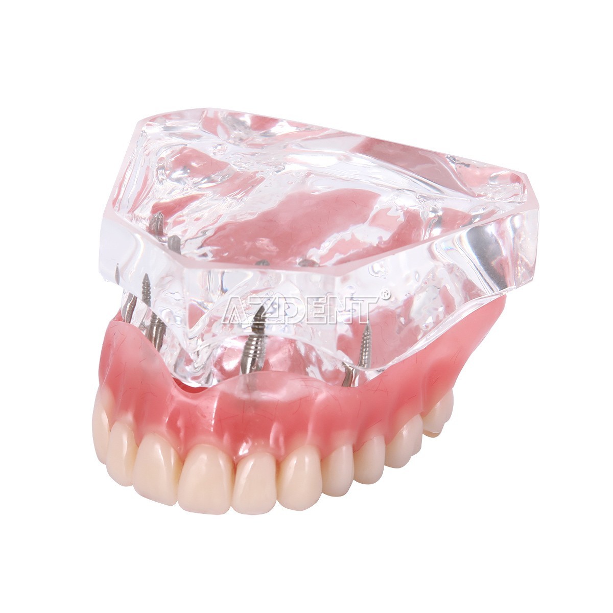 Dental Implant Teeth Model Demo Overdenture Restoration With Implants Lower 6003