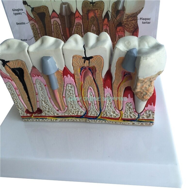 Diseased Teeth and Gums anatomical model-Dental Hygiene Tooth Medical anatomy