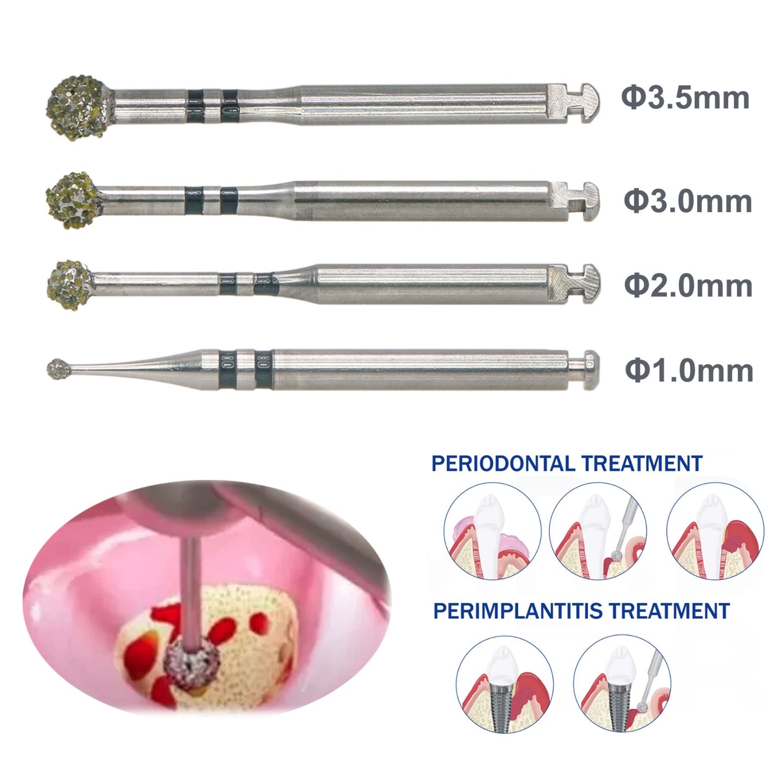 4Pcs/Kit Degranulation Burs Kit Osseous Debridement Remove Bone Tissue Remnant