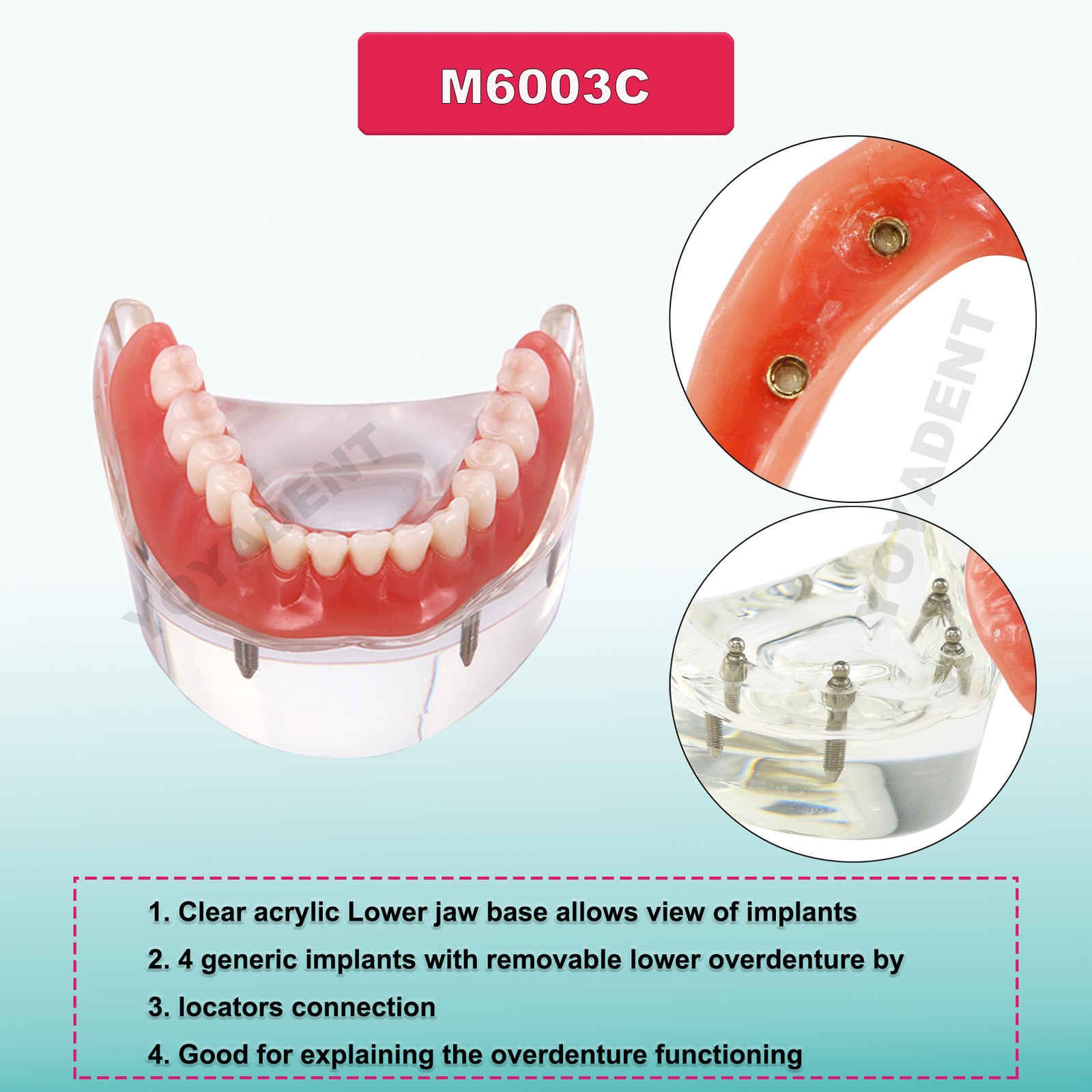 Dental Teeth Model Upper Lower Jaw 4 Overdenture Practice Implant Typodont Demo