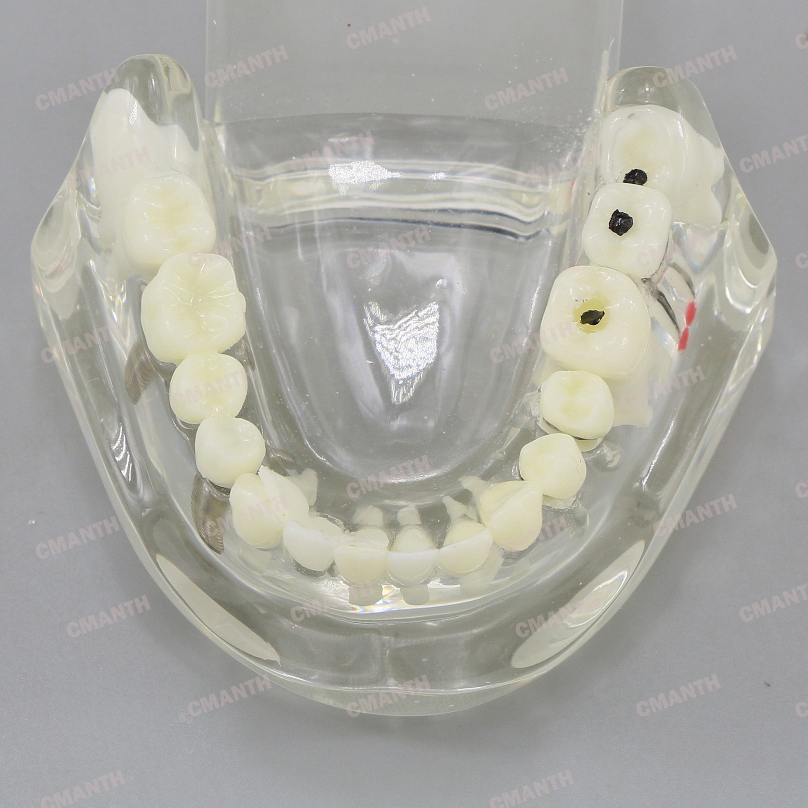 Dental Teeth Model Ortho Implant Practice Teaching of Implants Demo Model