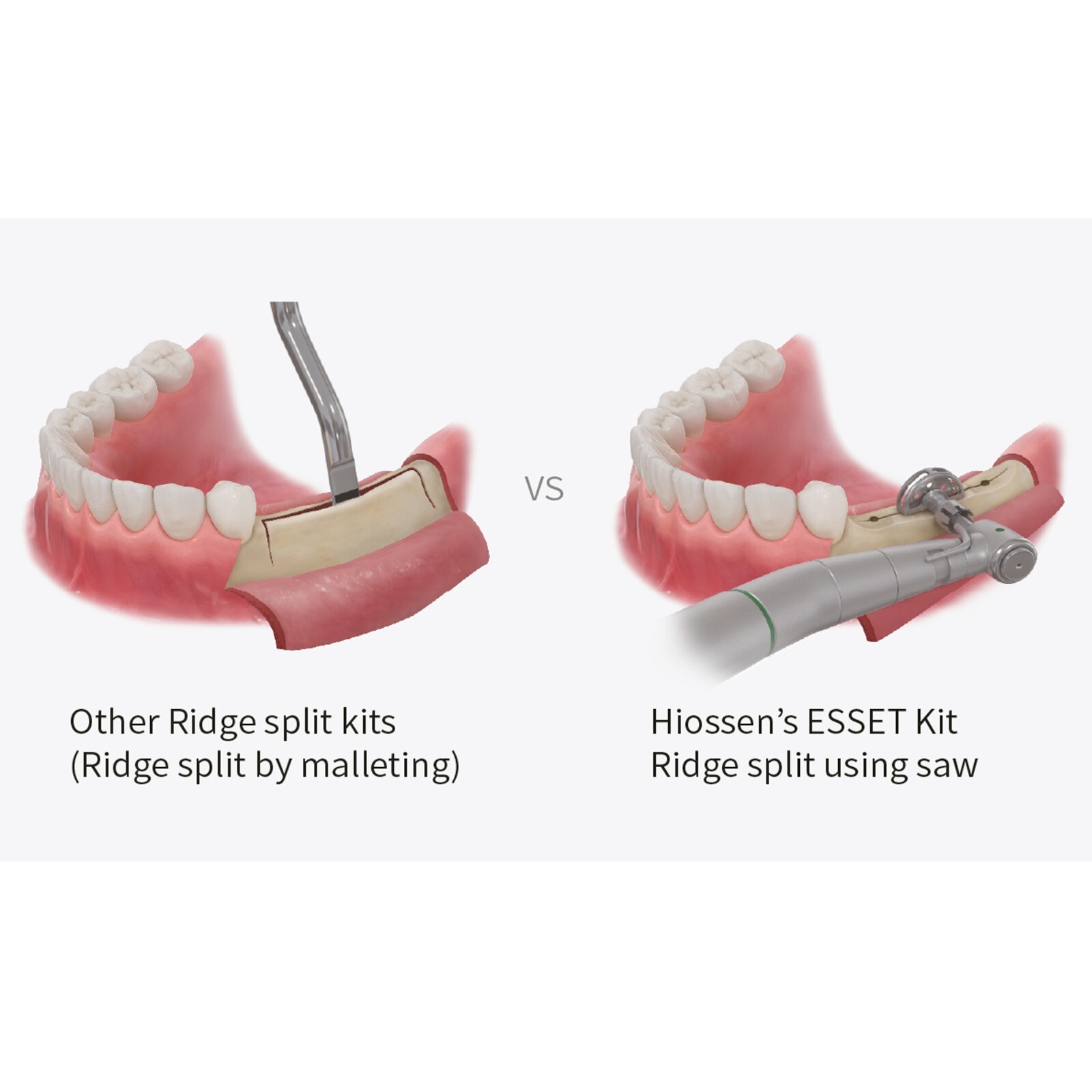 Implant ESSET Kit Easy Split Expansion of the Narrow Ridge HIOSSEN OSSTEM Style