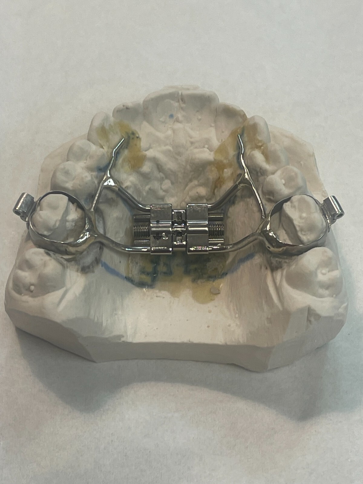 (1) SCREW ——-Leone Rapid Palatal Expansion screw { 15 mm. of expansion }