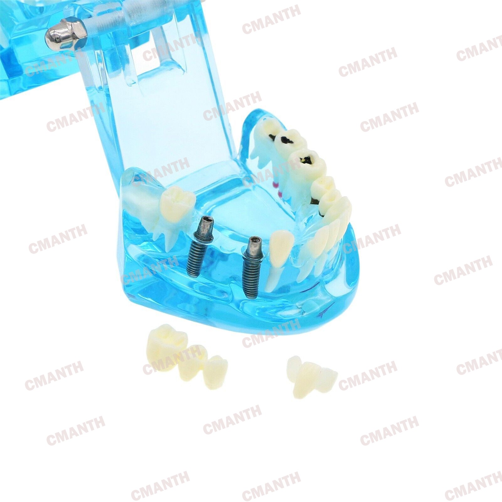Dental Teeth Model Ortho Implant Practice Teaching of Implants Demo Model