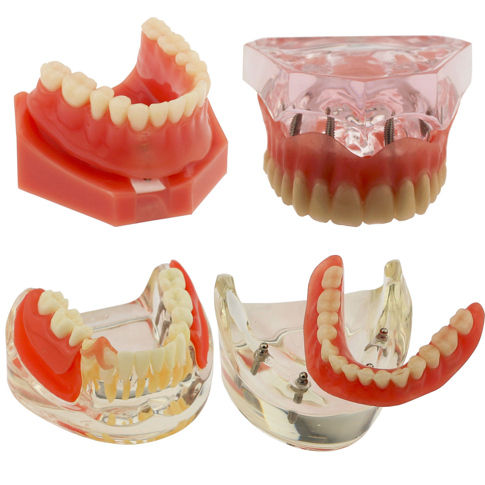Dental Implants Restoration Model Overdenture Inferior With Demo Teaching Study