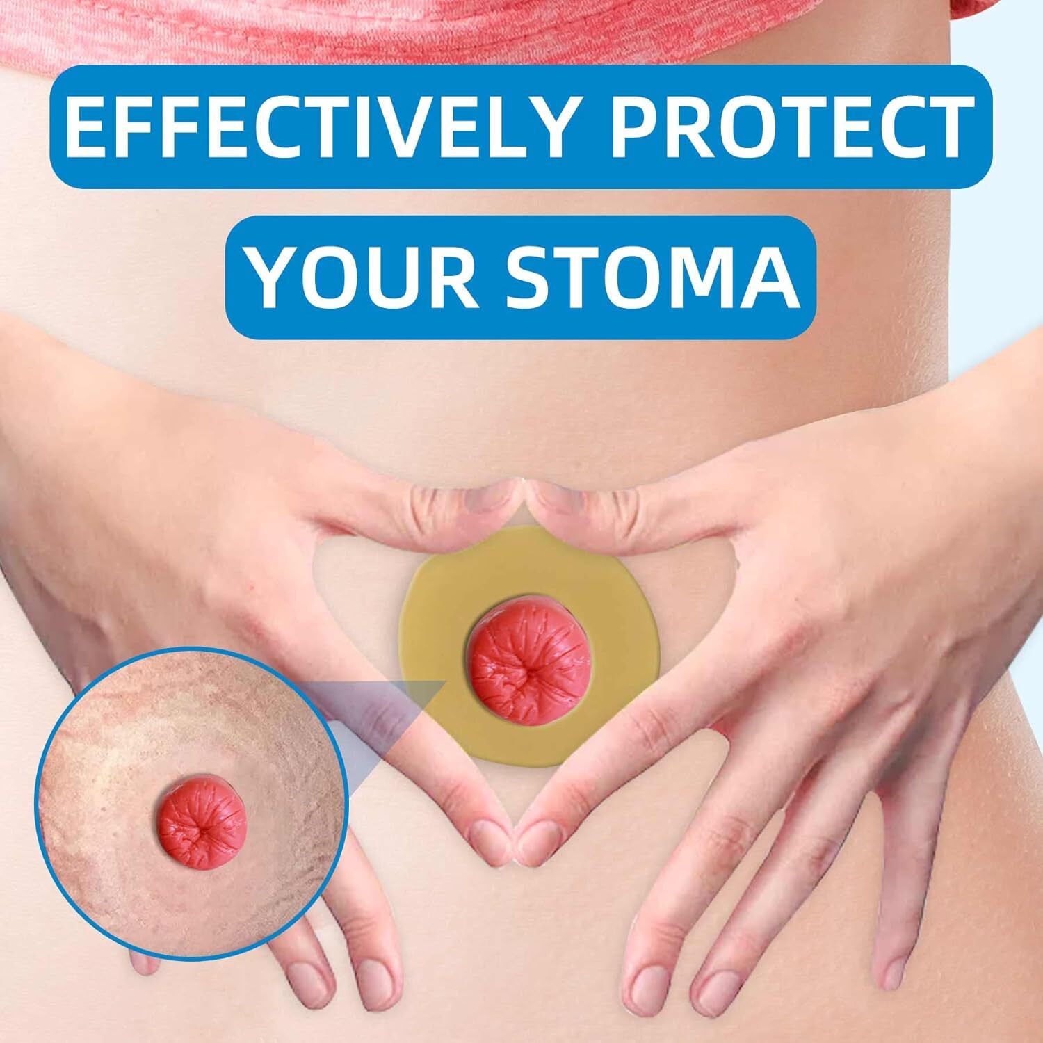 10PCS Ostomy Barrier Rings, Moldable Hydrocolloid for Colostomy Bags