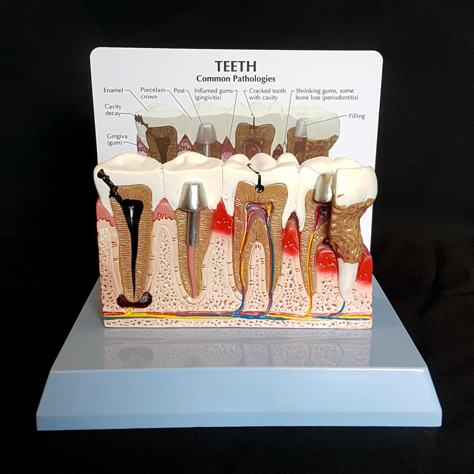 Anatomical Diseased Teeth and Gums Model – Dental Hygiene Medical Tooth Anatomy