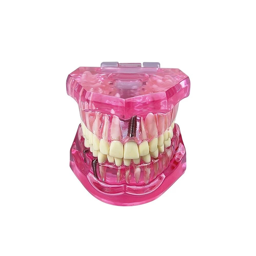 Dental Teeth Model Ortho Implant Practice Teaching With Implants Demo Model