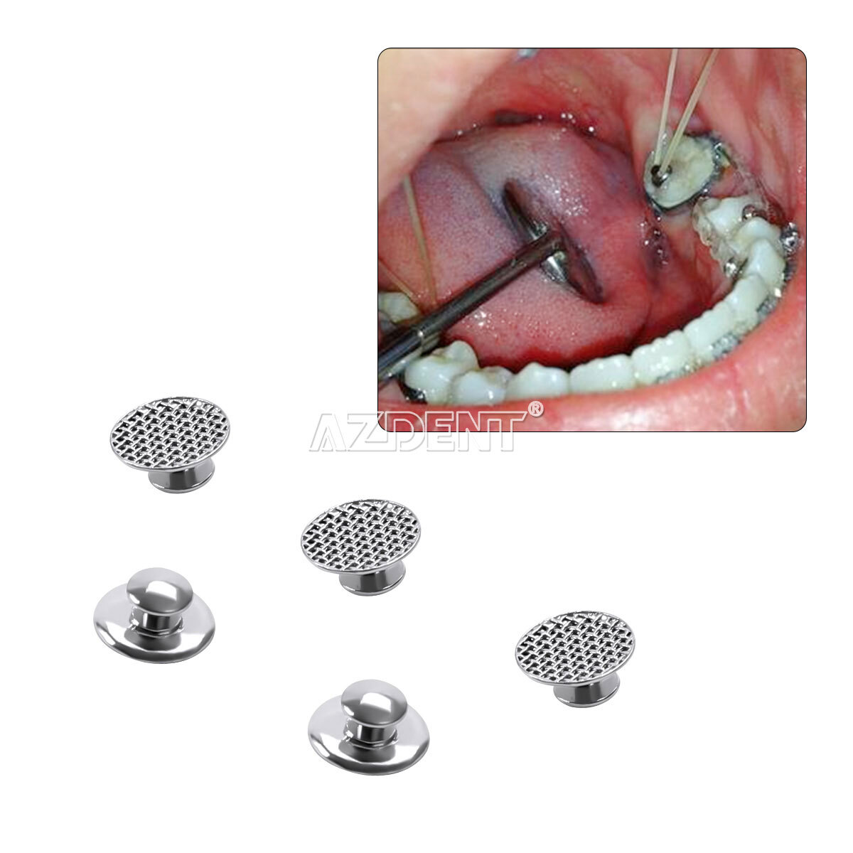 100pcs Dental Orthodontic Lingual Buttons Round Mesh Base Bondable Metal