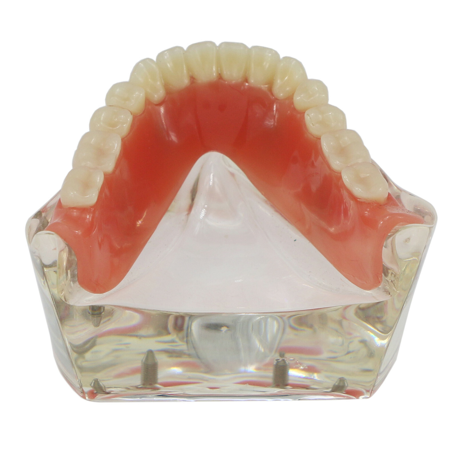 Dental Typodont Teeth Model Overdenture Lower Inferior 4 Implants Demo M6003