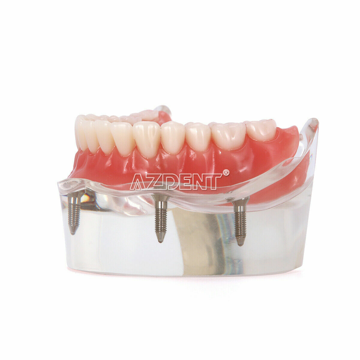 Dental Demonstration 4 Implants Teeth Model Typodont Inferior Overdenture Lower