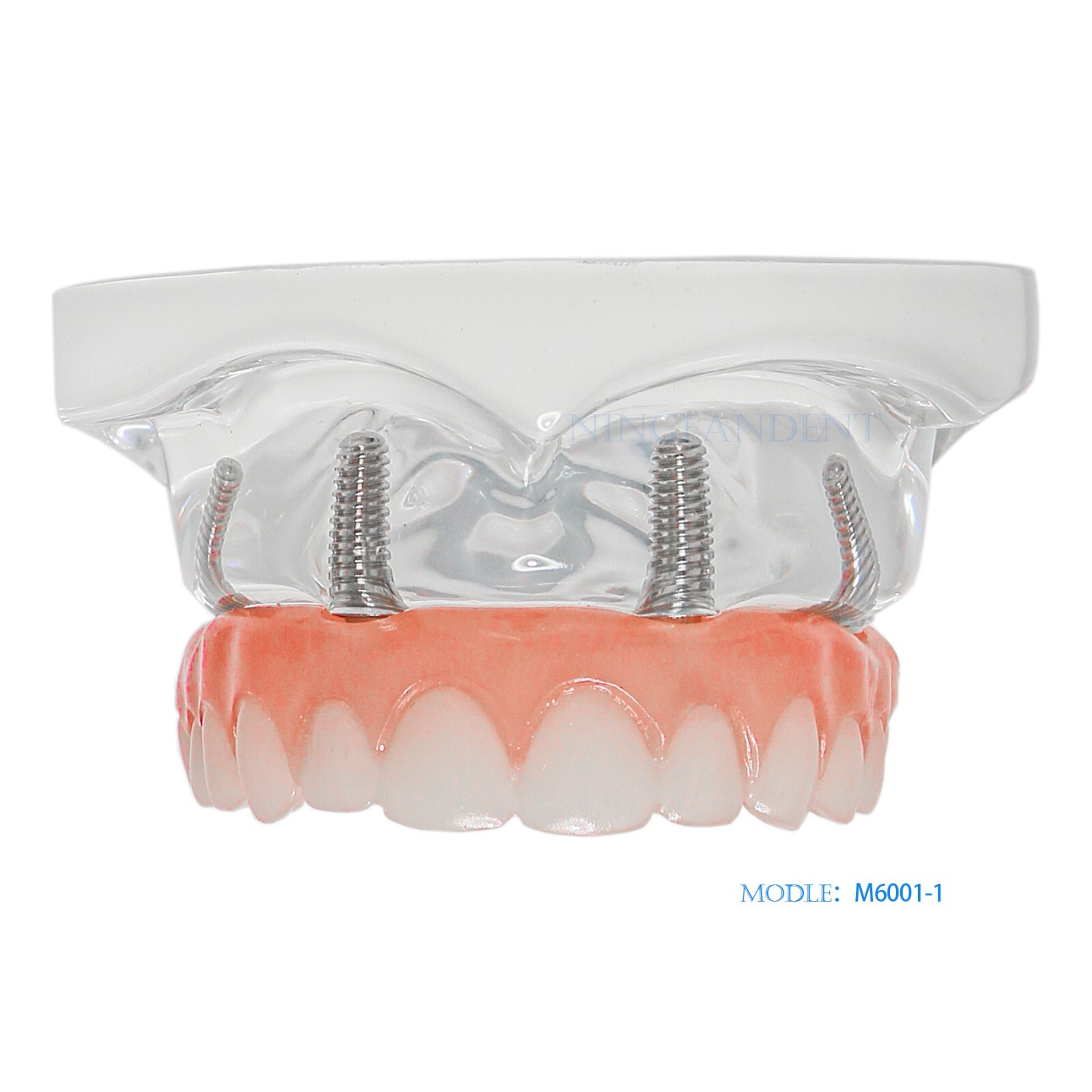 USAll on 4 Dental Implant Model Overdenture Upper Jaw 4 Implant Clear Detachable