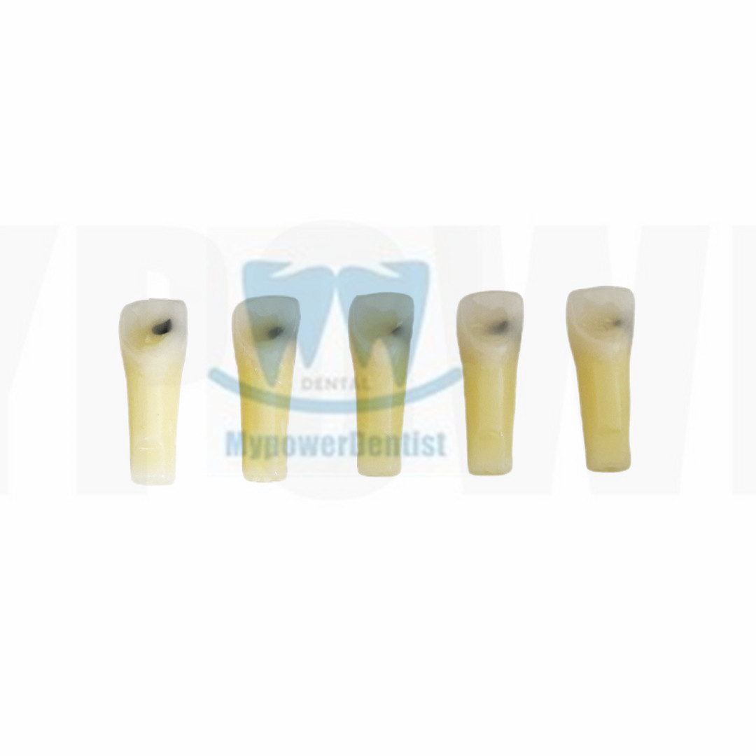 Dental Cavity Preparation/Vitro Decay Caries Model/Composite Resin Filling Model