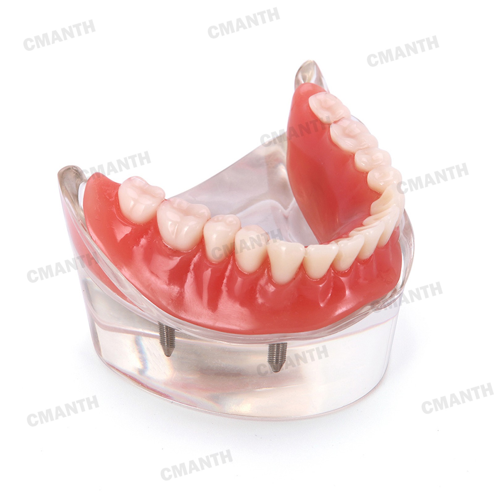 US Dental Model Removable Overdenture Teeth Upper/Lower Jaw 4 Implants Model