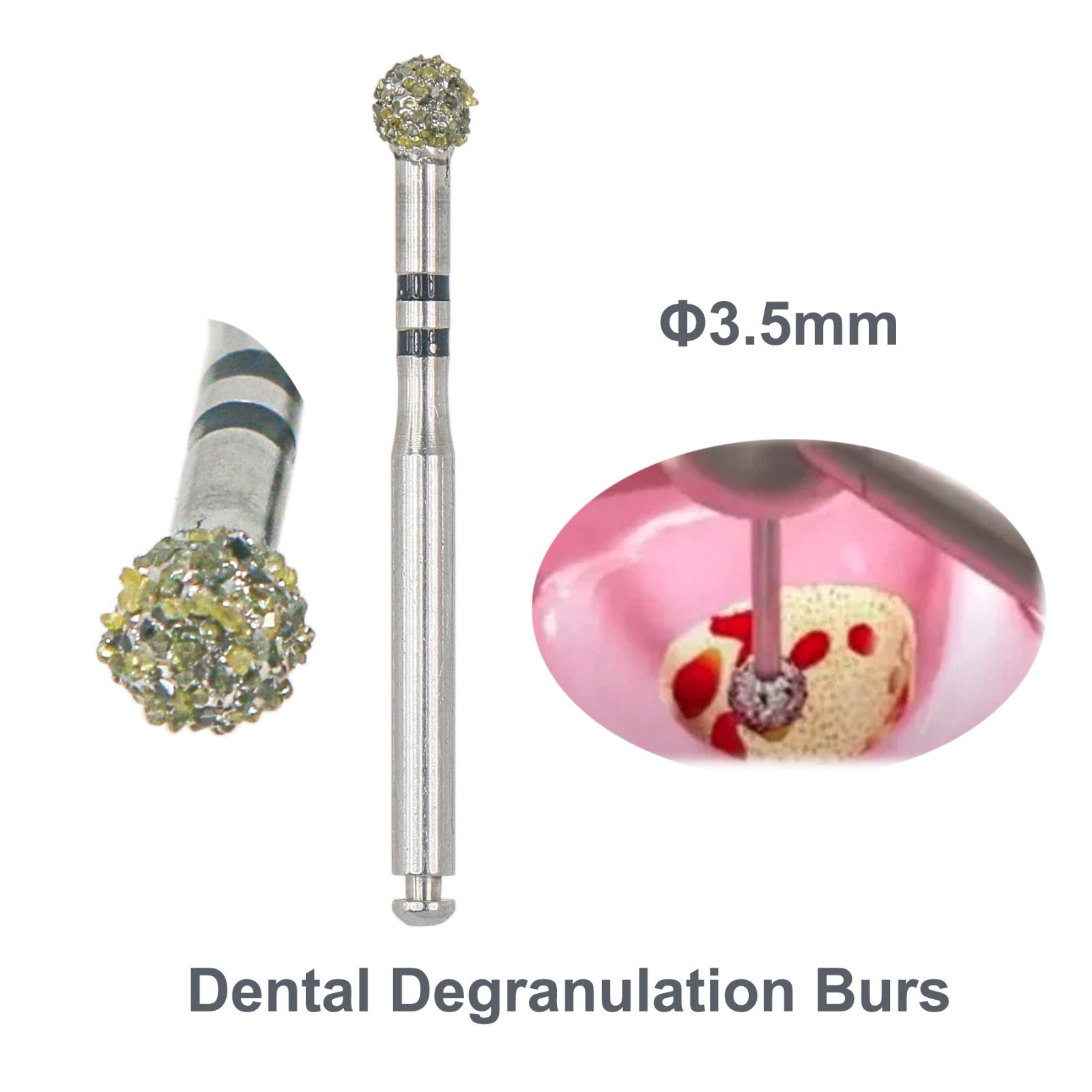 Dental Degranulation Burs Soft Tissue Removal Implant Surgery 1.0–3.5mm 4pcs Kit