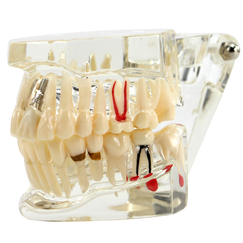 3D Teeth Model Dental Oral Typodont Model Ortho Implant Pathological Demo Model