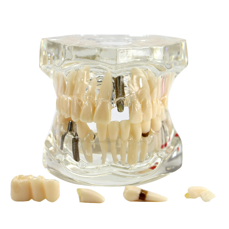 3D Teeth Model Dental Oral Typodont Model Ortho Implant Pathological Demo Model