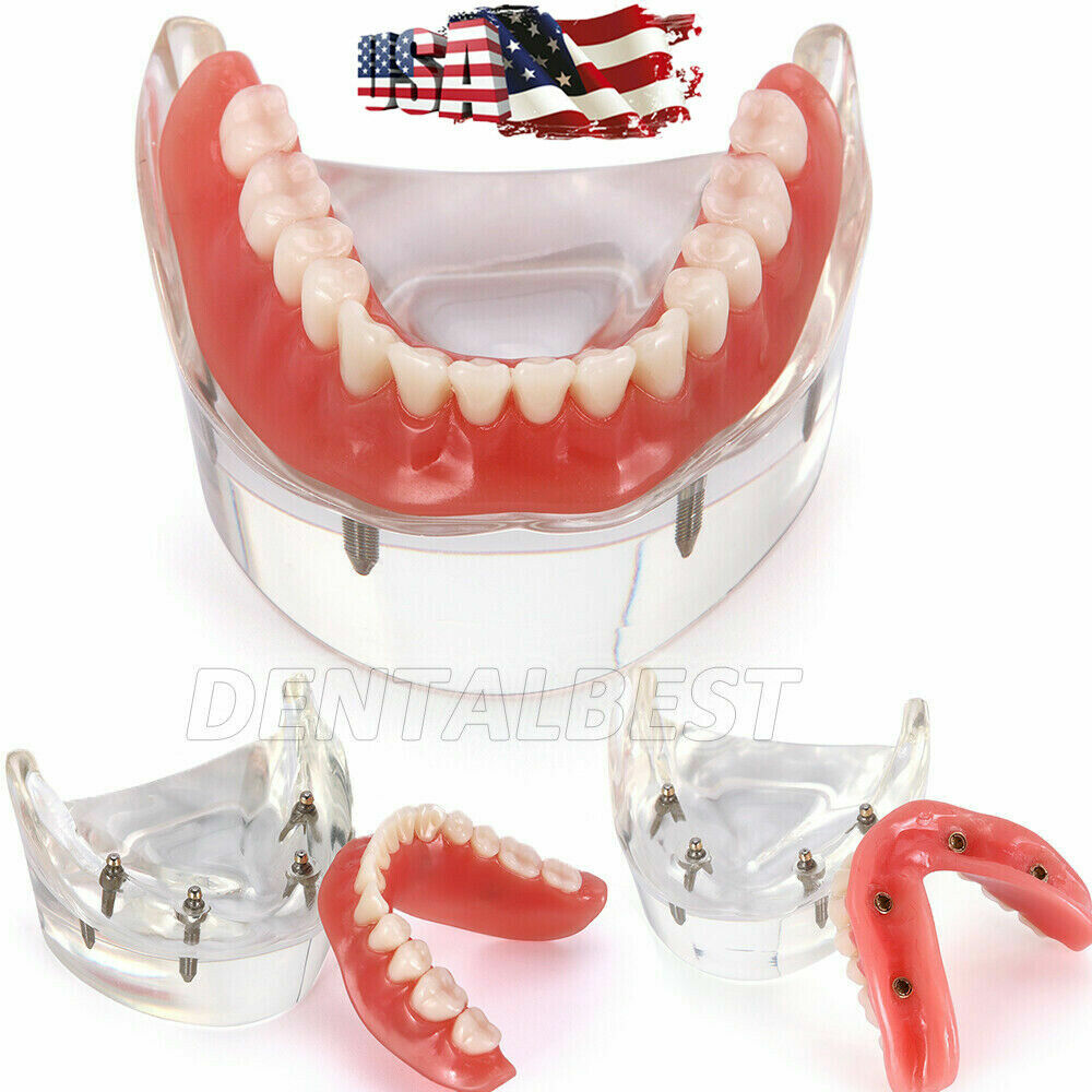Dental Demonstration 4 Implants Teeth Model Typodont Inferior Overdenture Lower