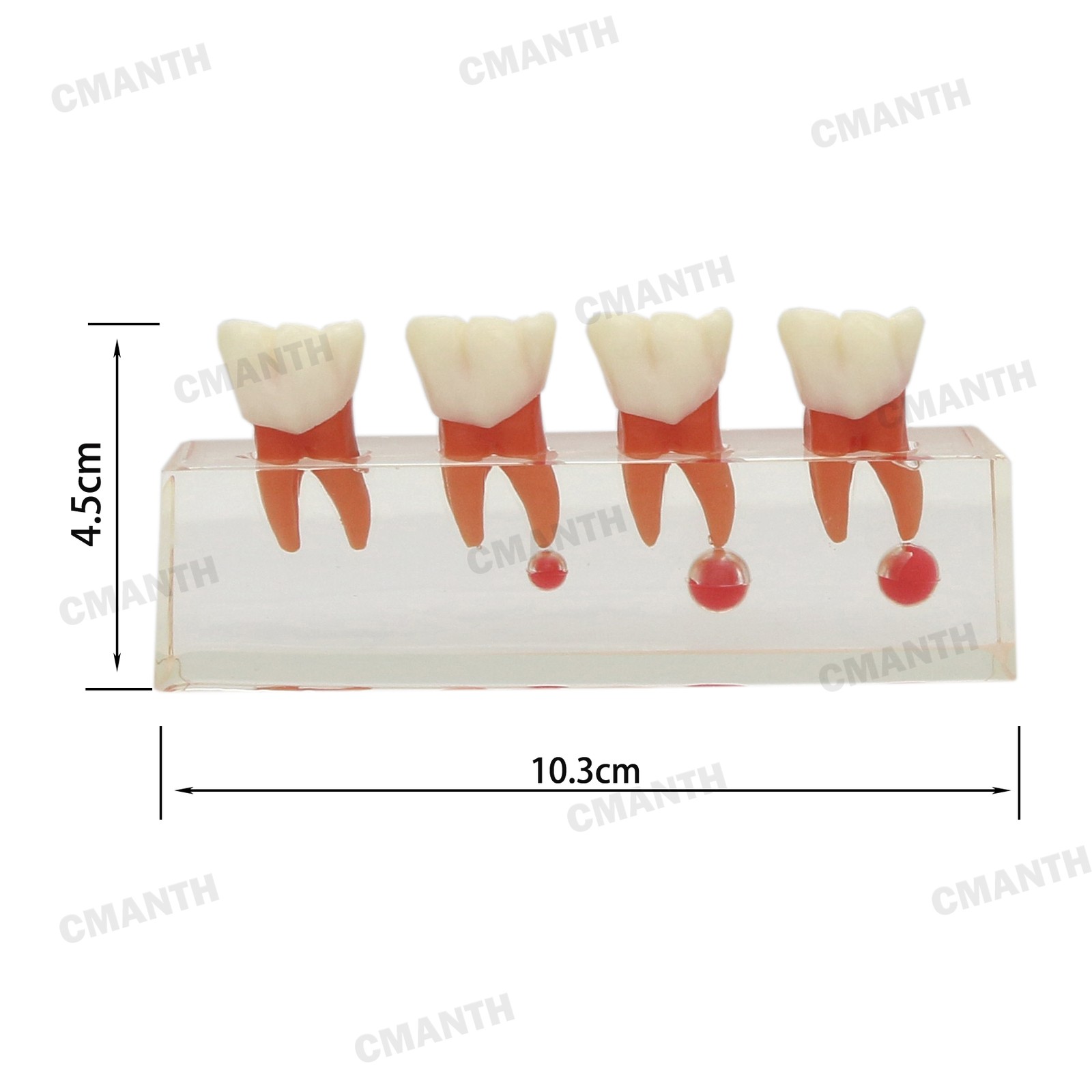 US Dental Teeth Model 4-Stage Molar Root Canal Caries Endodontic Treatment Study