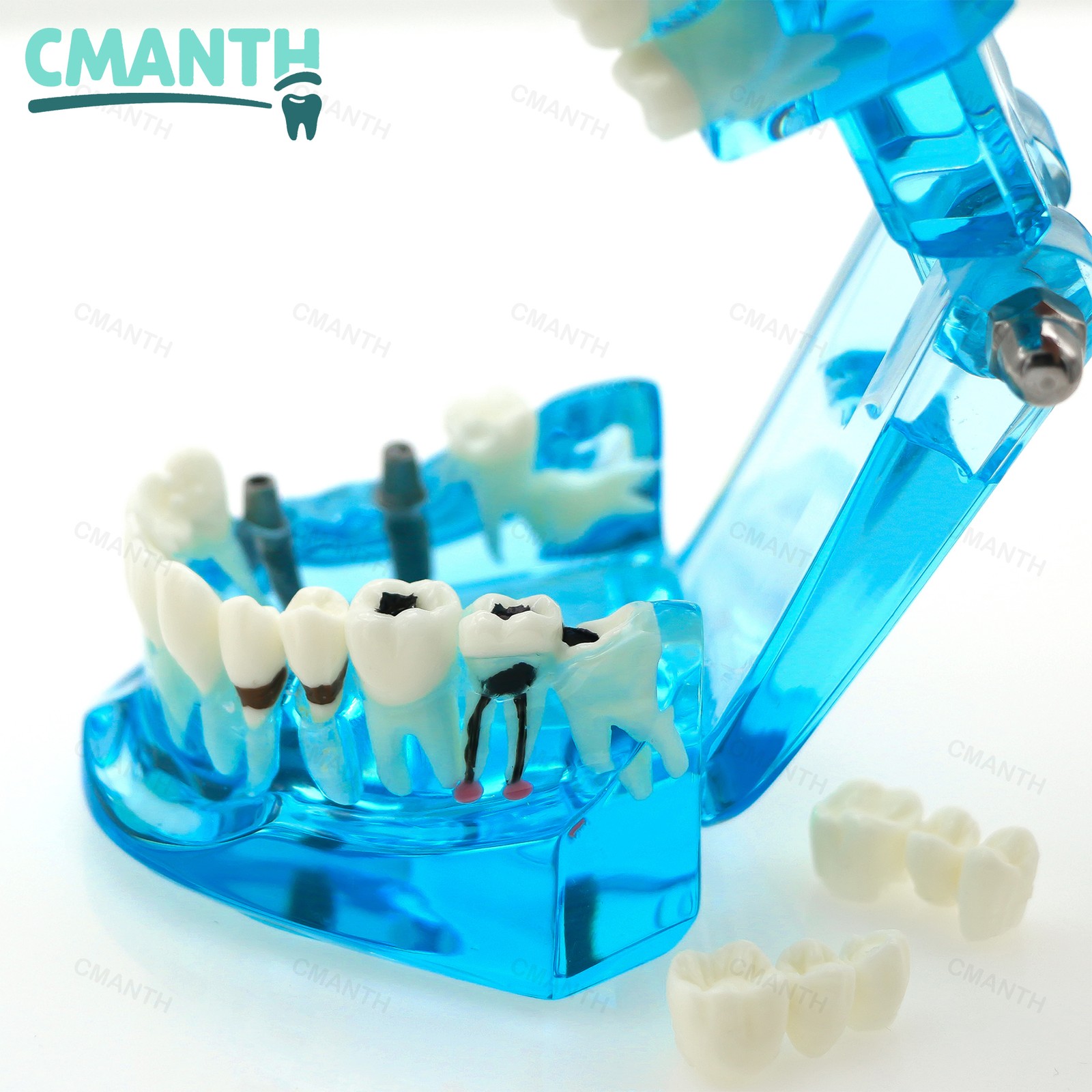 Dental Model Bridge Restoration Pathology Study Demo Teaching Model M2001