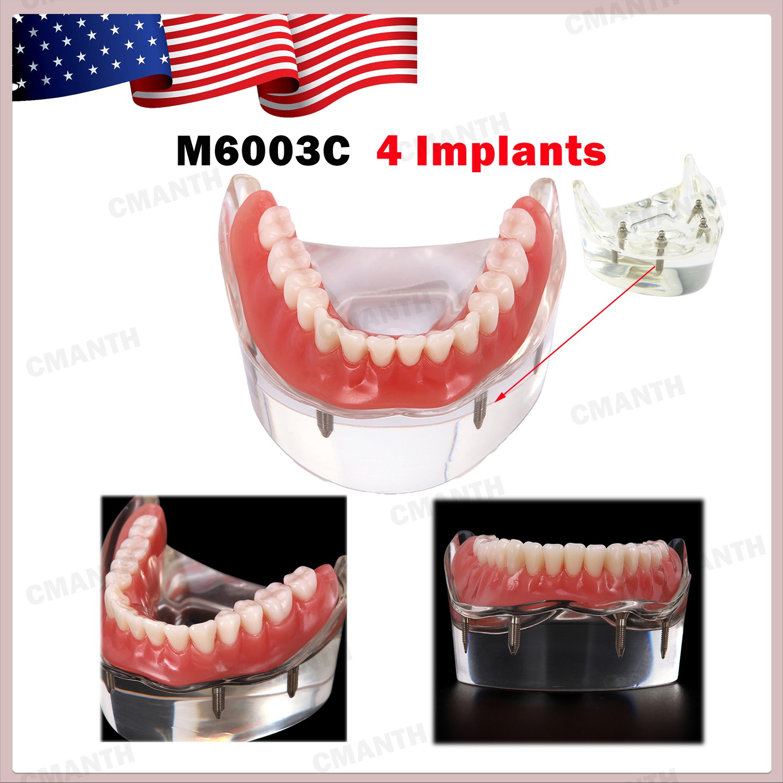 US Dental Model Removable Overdenture Teeth Upper/Lower Jaw 4 Implants Model