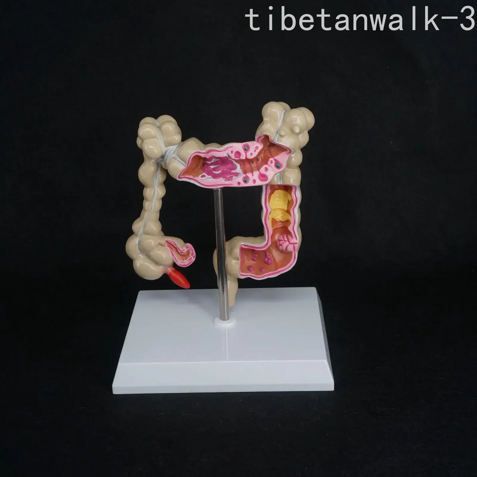 Anatomical Human Colon Large Intestine Pathological Diseases Model