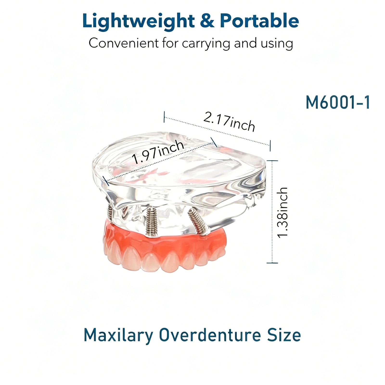 USAll on 4 Dental Implant Model Overdenture Upper Jaw 4 Implant Clear Detachable